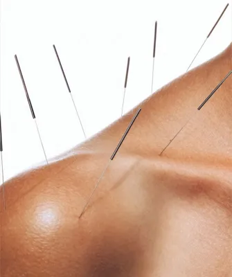 حجامت امبدینگ طب سوزنی در اصفهان 