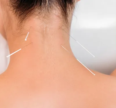 حجامت امبدینگ طب سوزنی در اصفهان 