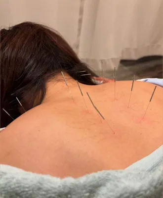 حجامت امبدینگ طب سوزنی در اصفهان 