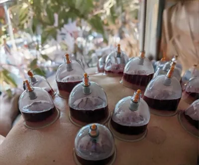 حجامت امبدینگ طب سوزنی در اصفهان 