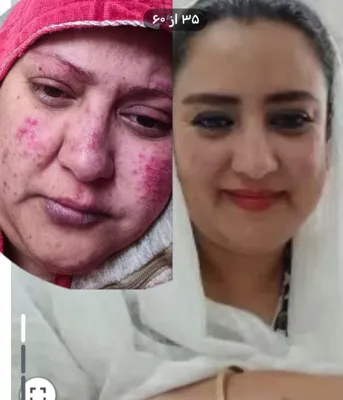 درمان چاقی و اگزمای پوستی در چندماه فقط با دمنوش ها و روغنهای طبیعی نیوشا