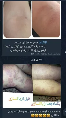 درمان  اگزمای پوستی در چندماه فقط با و روغنهای طبیعی نیوشا