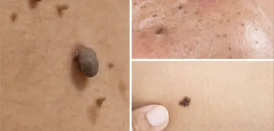 درمان قطعی زگیل تناسلی در اصفهان 