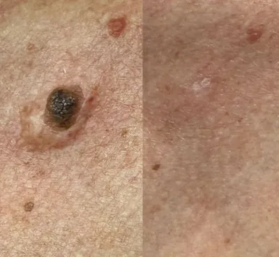 درمان قطعی زگیل تناسلی در اصفهان 