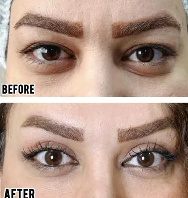 بلفاروپلاستی،لیفت صورت،کاشت مو در اصفهان 