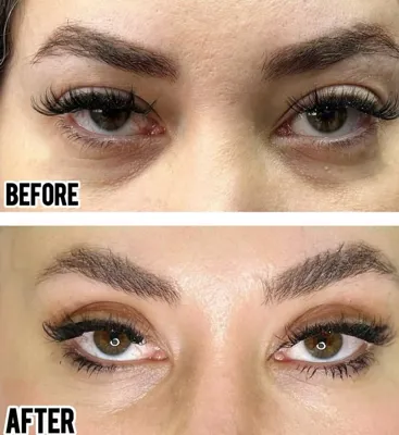 بلفاروپلاستی،لیفت صورت،کاشت مو در اصفهان 