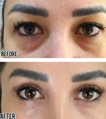 بلفاروپلاستی،لیفت صورت،کاشت مو در اصفهان 