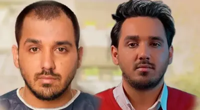 بلفاروپلاستی،لیفت صورت،کاشت مو در اصفهان 