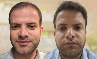 بلفاروپلاستی،لیفت صورت،کاشت مو در اصفهان 