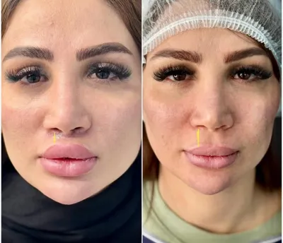 بلفاروپلاستی،لیفت صورت،کاشت مو در اصفهان 