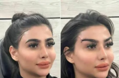 بلفاروپلاستی،لیفت صورت،کاشت مو در اصفهان 