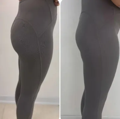 تزریق فیلر بادی در اصفهان 