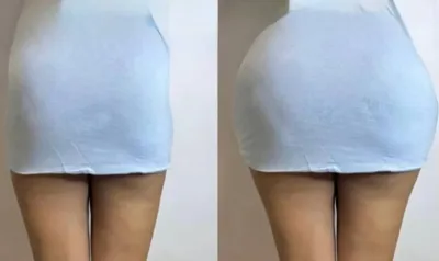 لیفت باسن در اصفهان 