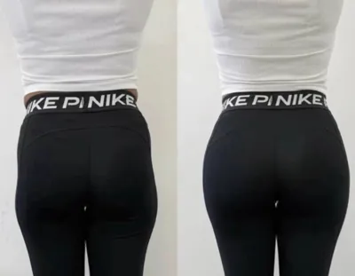 تزریق فیلر بادی در اصفهان 