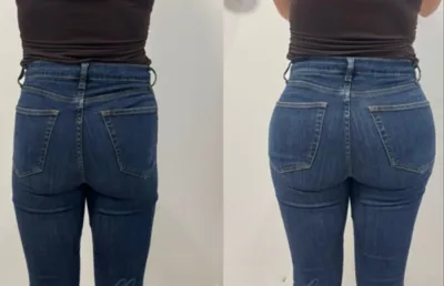 تزریق فیلر هیپ دیپ در اصفهان 