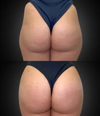 فیلر بادی بوتاکس در اصفهان

تزریق فیلر بادی در اصفهان 