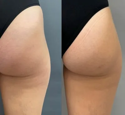 تزریق هیپ دیپ در اصفهان 