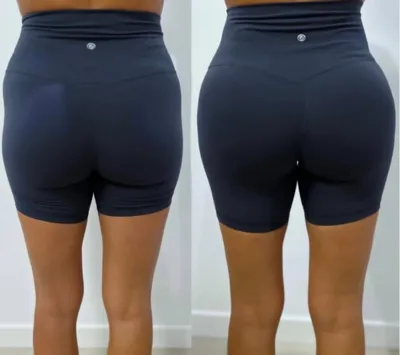 تزریق فیلر باسن 