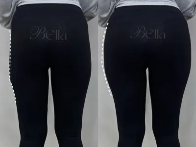 تزریق فیلر بادی در اصفهان 