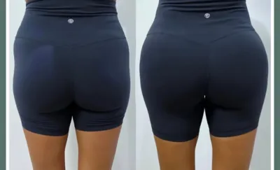 تزریق فیلر بادی در اصفهان 