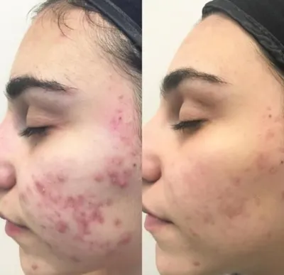 فشیال تخصصی در اصفهان