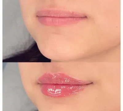 تزریق فیلر زیر چشم بینی لب در اصفهان 