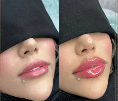 تزریق فیلر زیر چشم بینی لب در اصفهان