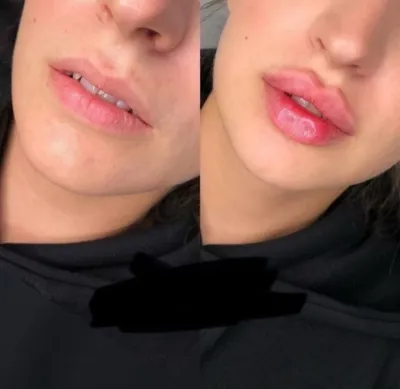 تزریق فیلرزیرچشم بینی لب دراصفهان 