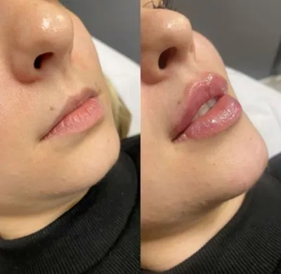 تزریق فیلرزیرچشم بینی لب دراصفهان