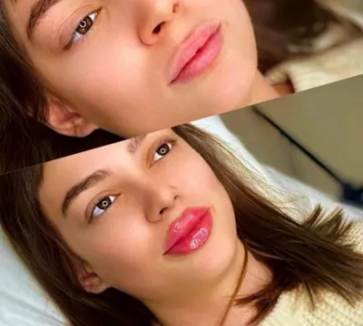 تزریق فیلرزیرچشم بینی لب دراصفهان 