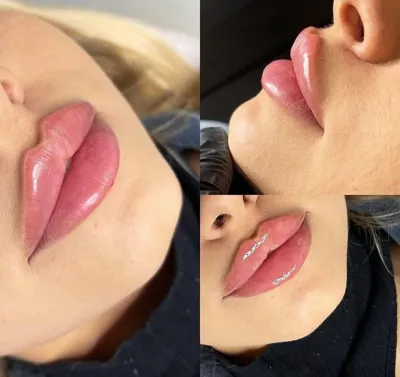 تزریق فیلرزیرچشم بینی لب دراصفهان 