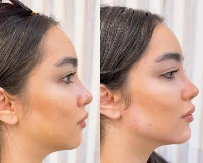 تزریق فیلرزیرچشم بینی لب دراصفهان