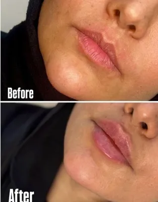 تزریق فیلرزیرچشم بینی لب دراصفهان 