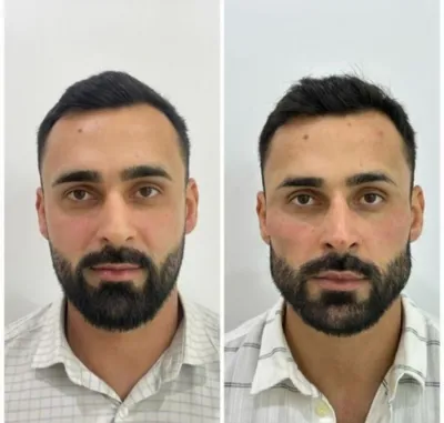 تزریق فیلرزیرچشم بینی لب دراصفهان 

تزریق مادلینگ فول فیس 