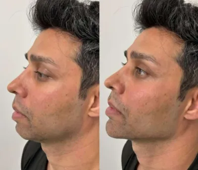 تزریق فیلرزیرچشم بینی لب دراصفهان  تزریق مادلینگ فول فیس 