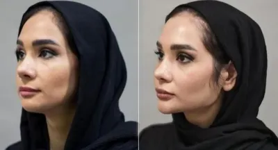 تزریق فیلر زیر چشم بینی لب دراصفهان 