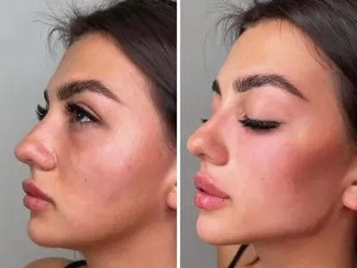 تزریق فیلرزیرچشم بینی لب دراصفهان 