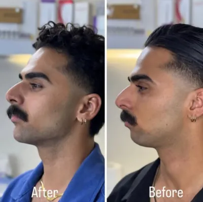 تزریق فیلرزیرچشم بینی لب دراصفهان