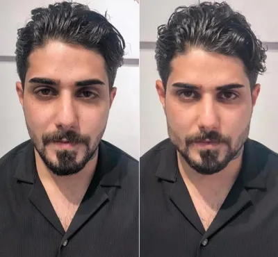 تزریق فیلرزیرچشم بینی لب دراصفهان 