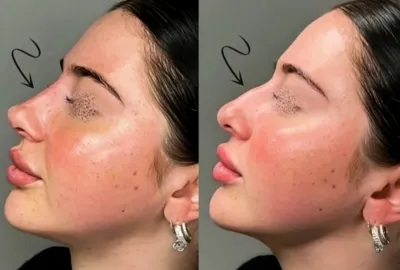 تزریق فیلرزیرچشم بینی لب در اصفهان 