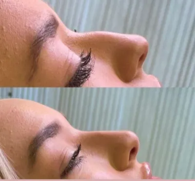 تزریق فیلرزیرچشم بینی لب دراصفهان