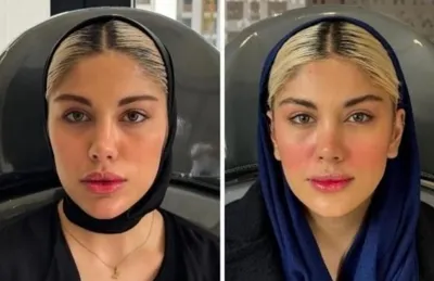 تزریق فیلرزیرچشم بینی لب دراصفهان 