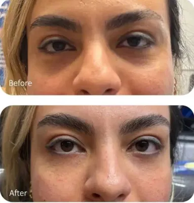 تزریق فیلر زیر چشم بینی لب در اصفهان 