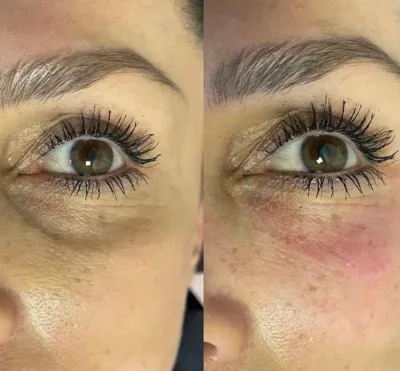 تزریق فیلرزیرچشم بینی لب دراصفهان 