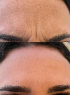 تزریق فیلر زیر چشم بینی لب در اصفهان 