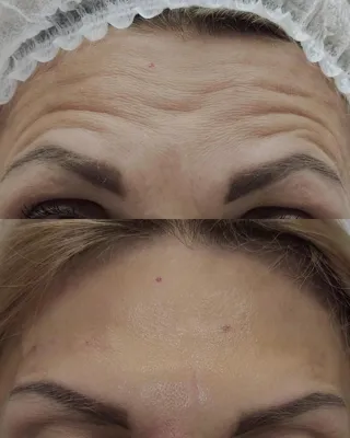 تزریق فیلر زیر چشم بینی لب در اصفهان 