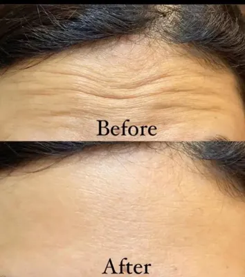 تزریق فیلر زیر چشم بینی لب در اصفهان 