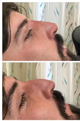 تزریق فیلر زیر چشم بینی لب در اصفهان 