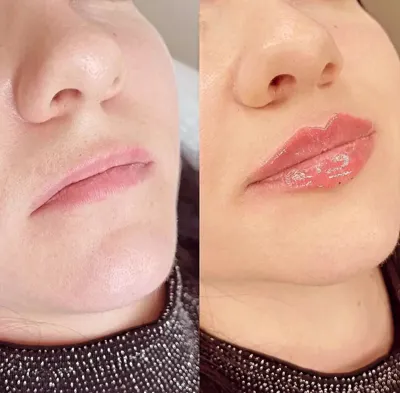 تزریق فیلر زیر چشم بینی لب در اصفهان 