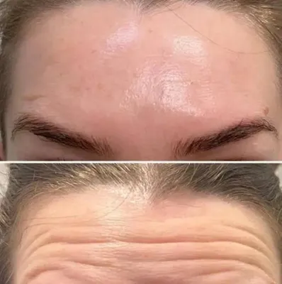 تزریق فیلر زیر چشم بینی لب در اصفهان 